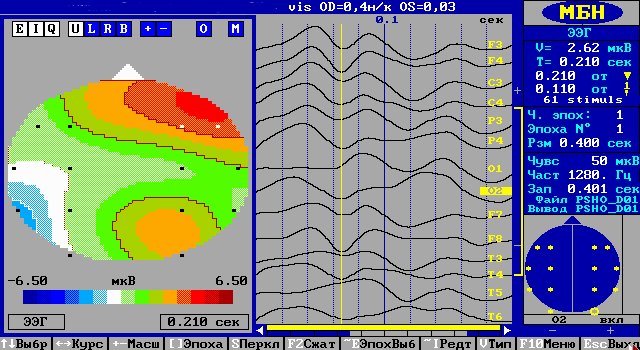 Оптохиазмальный арахноидит