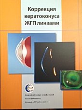 Коррекция кератоконуса ЖГП линзами
