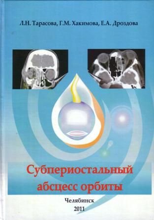 Субпериостальный абсцесс орбиты