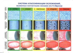 Система классификации осложнений вызванных контактными линзами (по Н. Эфрону)