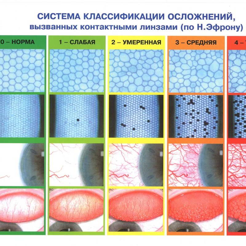 Система классификации осложнений вызванных контактными линзами (по Н. Эфрону)