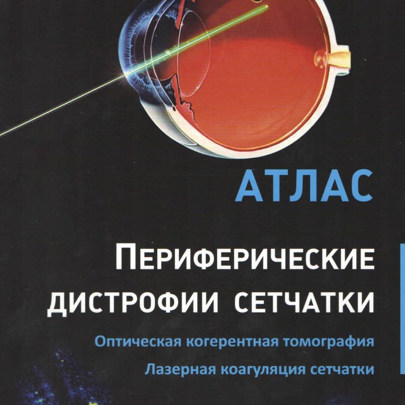 Периферические дистрофии сетчатки. Оптическая когерентная томография. Лазерная коагуляция сетчатки: