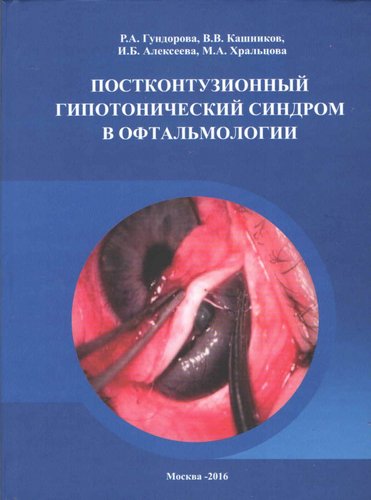 Постконтузионный гипотонический синдром в офтальмологии