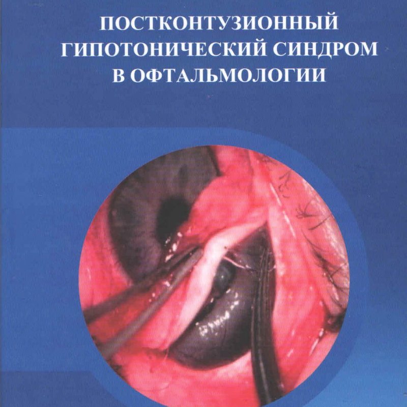 Постконтузионный гипотонический синдром в офтальмологии