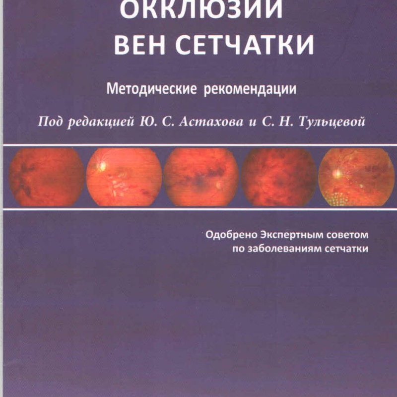 Окклюзии вен сетчатки.