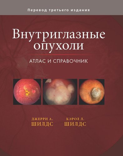 Внутриглазные опухоли. Атлас и справочник Том3.