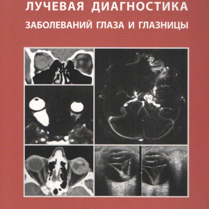 Лучевая диагностика заболеваний глаза и глазницы