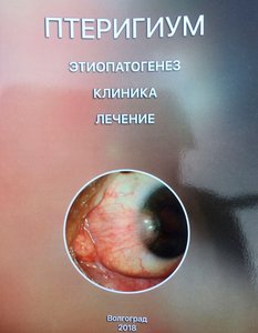 Птеригиум. Этиопатогенез. Клиника. Лечение.