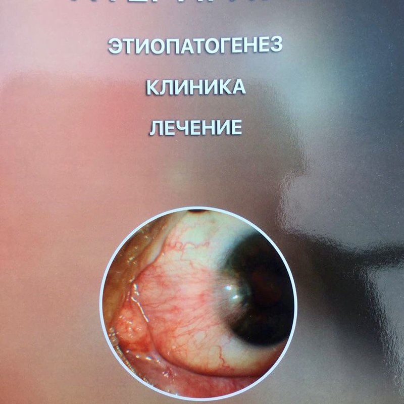 Птеригиум. Этиопатогенез. Клиника. Лечение.