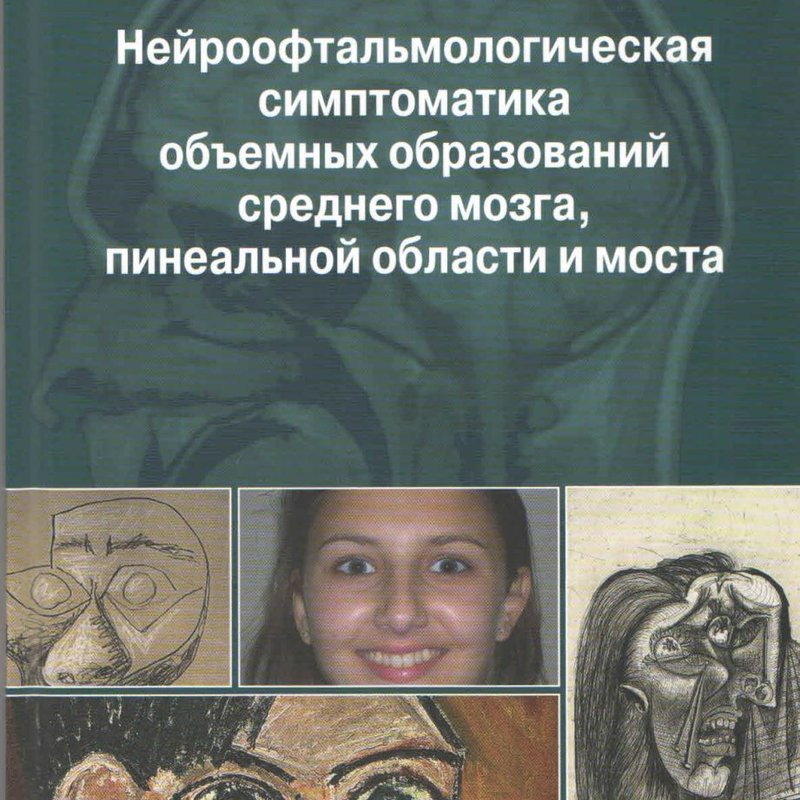 Нейроофтальмологическая симптоматика объемных образований среднего мозга, пинеальной области и мост