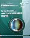 Патология глаза при псевдоэксфолиативном синдроме