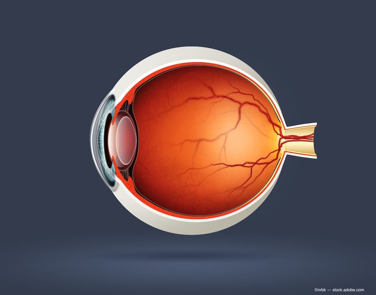 Хемоплаковая терапия ретинобластомы: потенциально новый и более доступный подход к лечению