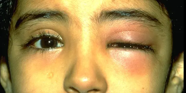 Существует ли «COVID-глаз»? Разбор орбитального целлюлита на фоне пандемии