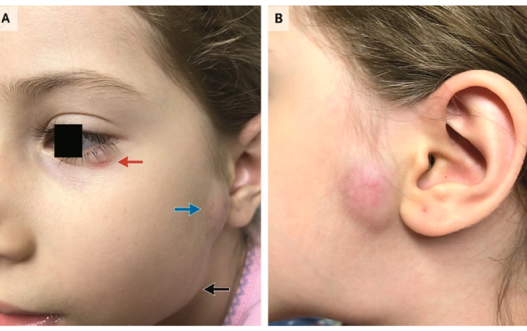 Синдром Парино окулогландулярный: этиология, клиническая картина и терапевтические подходы