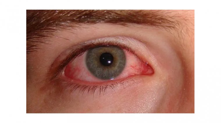 Весенний конъюнктивит: пять эффективных методов профилактики