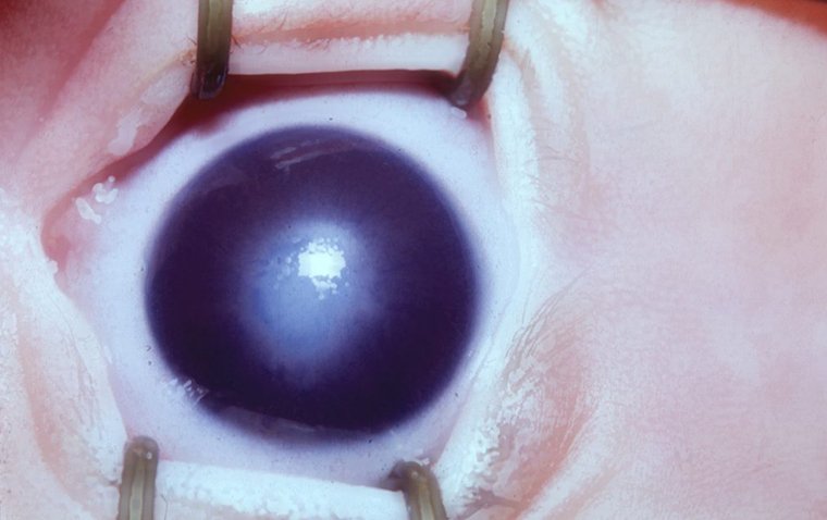 Аномалия Петерса: этиология, клиническая картина и подходы к лечению