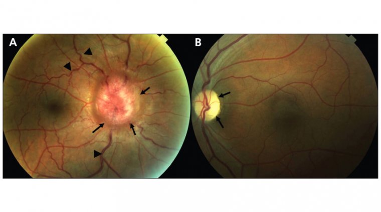 Синдром Фостера–Кеннеди: механизмы развития, дифференциальная диагностика и подходы к лечению
