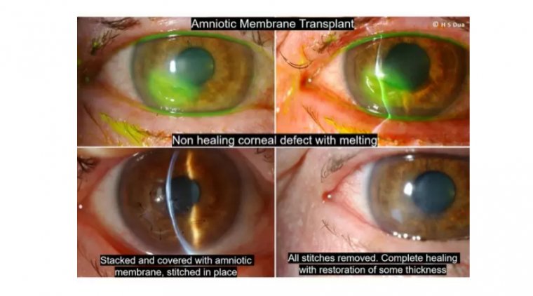 Трансплантация амниотической мембраны в офтальмологии: обзор метода