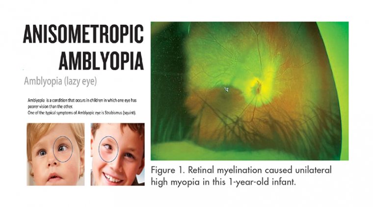 Детальный анализ анизометропической амблиопии у детей