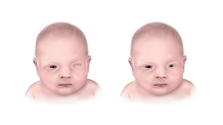 Анофтальм: этиология, диагностика и терапевтические подходы при редкой врожденной патологии