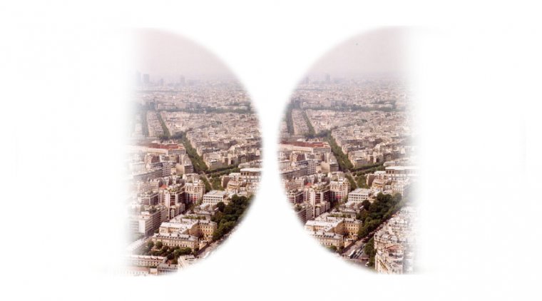 Битемпоральная гемианопсия: этиология, клиническая картина и подходы к ведению пациентов