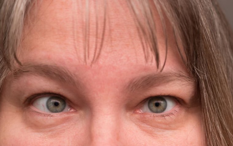 Испытание препарата донепезил открывает возможности для лечения амблиопии в позднем возрасте