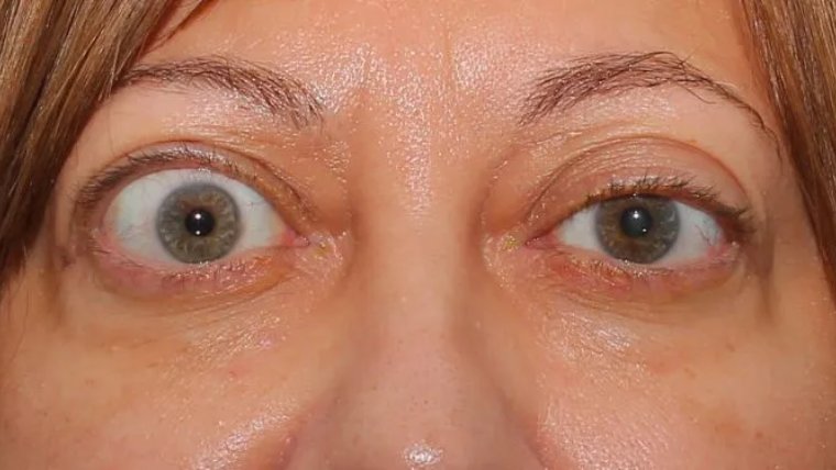 Экзофтальм: Этиология, Клиническая Картина и Современные Методы Лечения