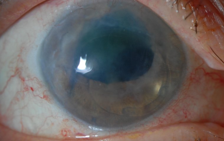 Буллезная кератопатия: этиология, клиническая картина и терапевтическая стратегия