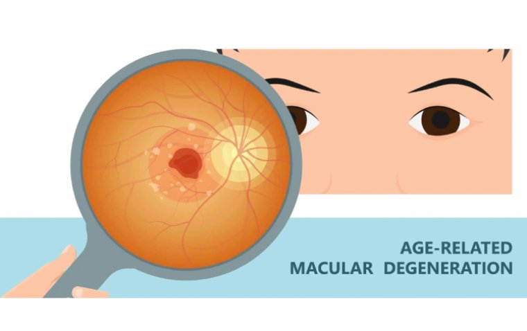 Возрастная макулярная дегенерация: факторы риска и современные подходы к сохранению зрения