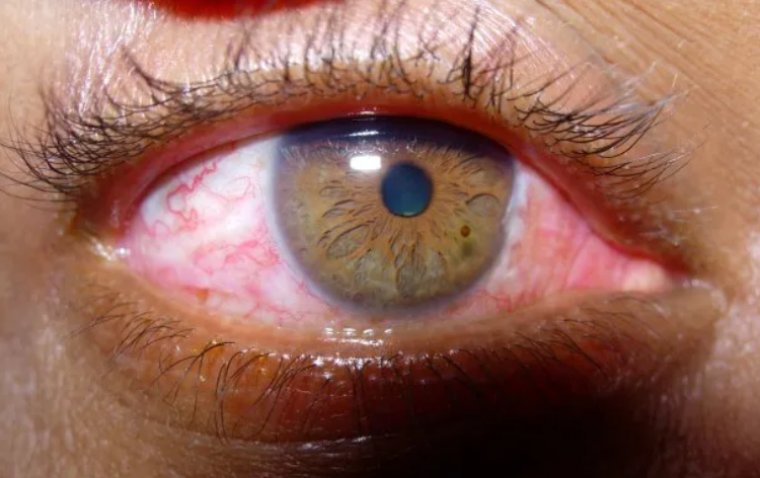 Инъекция конъюнктивы: этиология, клиническая картина и терапевтические подходы