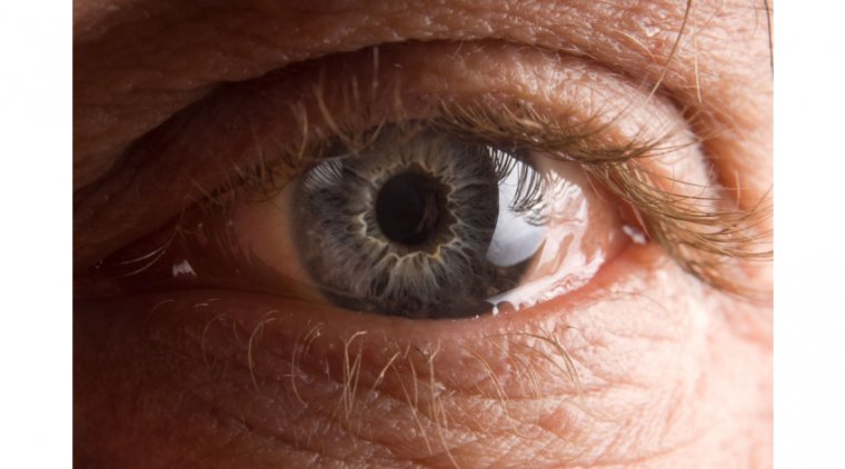 Конъюнктивохалязис: современный взгляд на патологию конъюнктивы