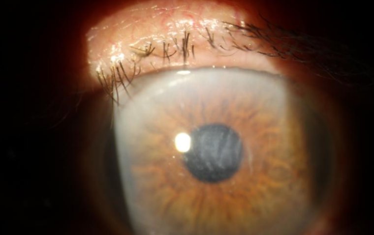 Отек роговицы: этиология, клиническая картина и терапевтические подходы