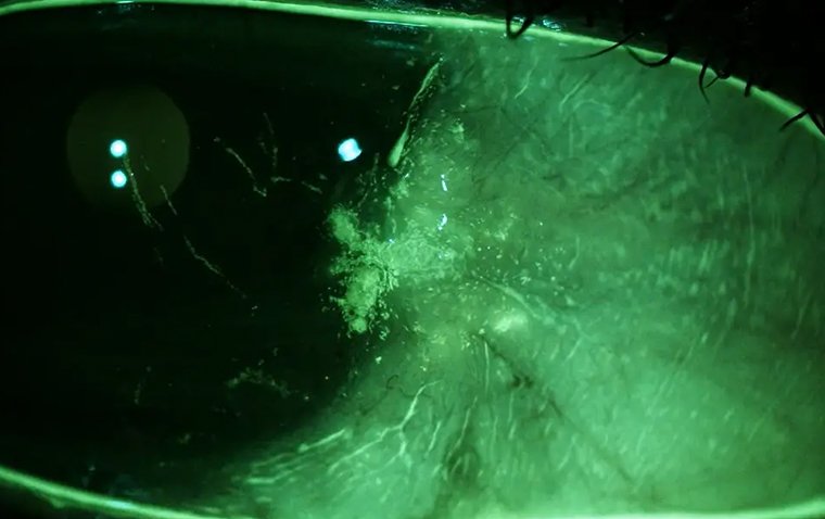 Окрашивание роговицы: анализ причин, симптоматики и терапевтических подходов