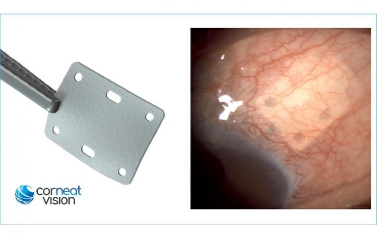 Компания CorNeat Vision вывела на рынок США синтетический имплантат CorNeat EverPatch
