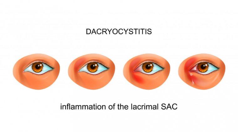 Дакриоцистит: Этиология, Клиническая Картина и Терапевтические Подходы
