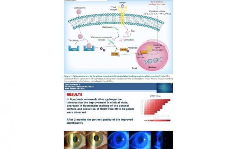 Применение циклоспорина в терапии синдрома сухого глаза: обзор эффективности, переносимости и фармакологических форм