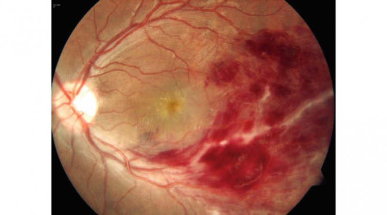Болезнь Илза: этиология, клиническая картина и терапевтические подходы