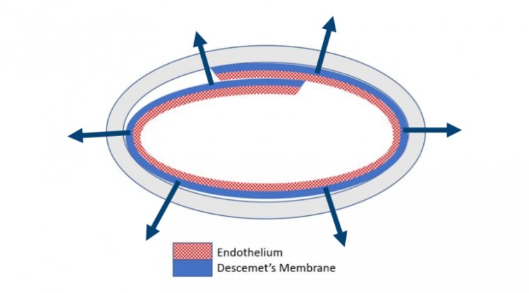 EverSight представила предварительно загруженную систему EndoGlide для эндотелиальной кератопластики (DMEK)