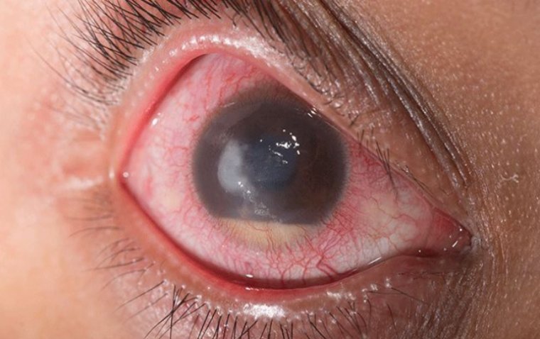 Эндофтальмит: этиология, клиническая картина и современные подходы к терапии