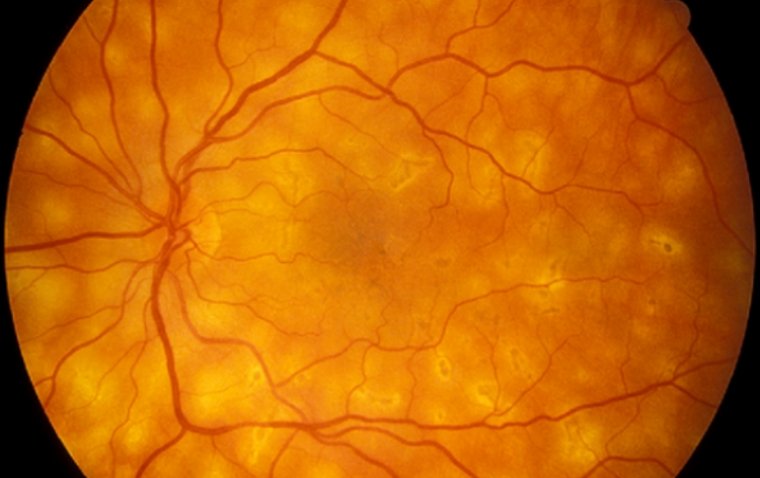 Редкая форма заднего увеита: современные методы диагностики и терапии птичьей хориоретинопатии