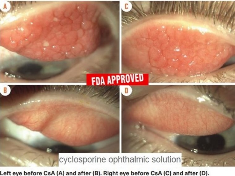 Управление по санитарному надзору за качеством пищевых продуктов и медикаментов США одобрило циклоспориновые глазные капли для лечения весеннего кератоконъюнктивита
