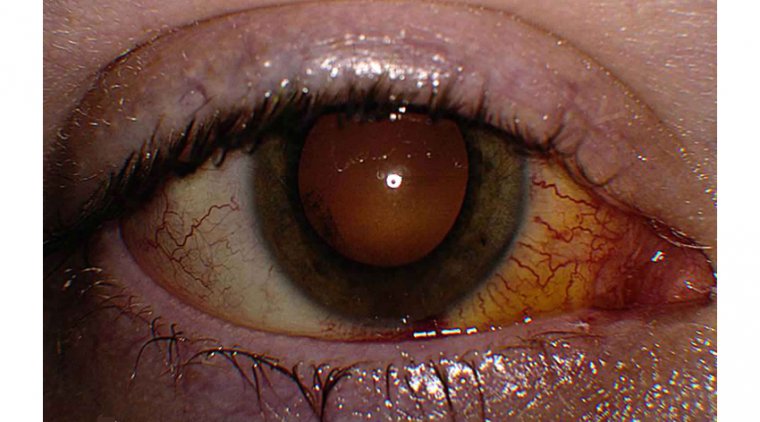 Хориоретинит: от диагностики к терапевтической стратегии