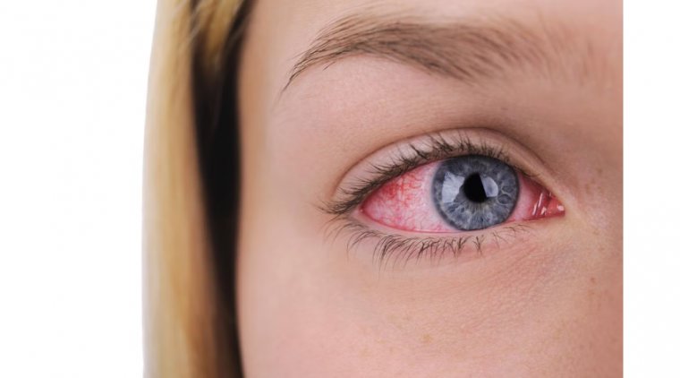 Сифилис глаза: этиология, клиническая картина и терапевтические подходы