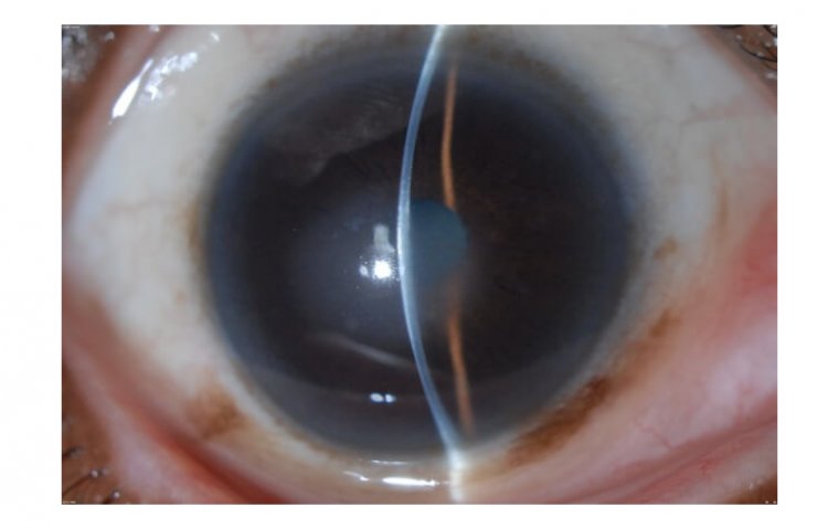 Дистрофия роговицы Фукса: этиология, клиническая картина и терапевтические подходы