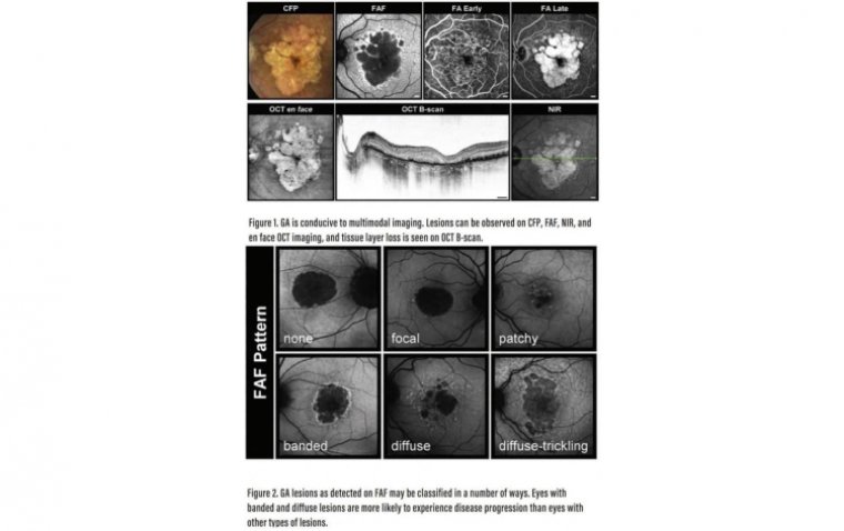 Географическая атрофия: клиническая характеристика и подходы к ведению пациентов