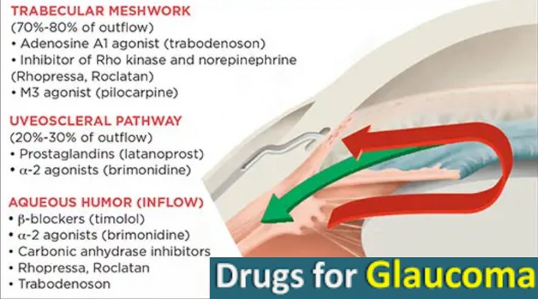 Обзор медикаментозных методов лечения глаукомы