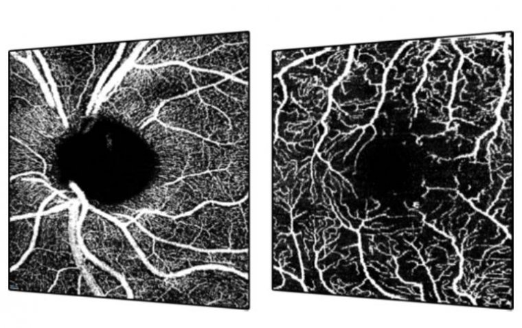 Heidelberg Engineering получила одобрение FDA на улучшенный модуль SPECTRALIS® OCTA