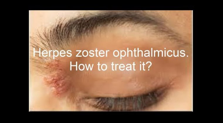 Офтальмологический герпес: клиническая картина, терапия и профилактика опоясывающего лишая в области глаза