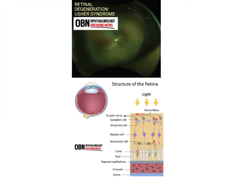 Подходы к ведению пациентов с синдромом Ашера и дегенерацией сетчатки