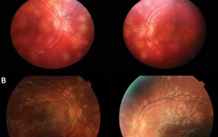 Идиопатический мультифокальный хориоидит: обзор эпидемиологии и факторов риска